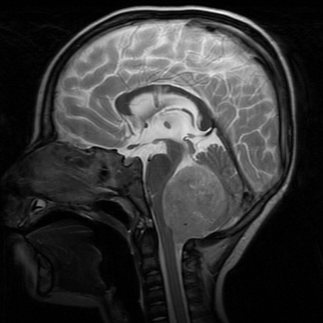 Patient A