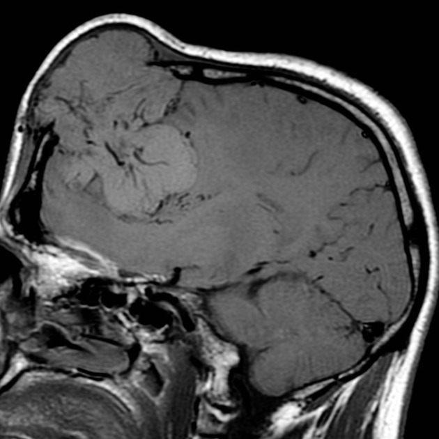 Meningeal hemangiopericytoma