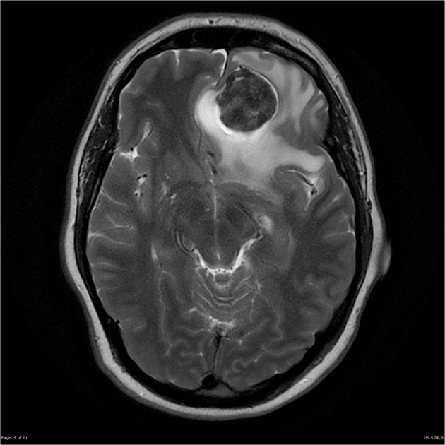 Solitary fibrous tumors of the dura