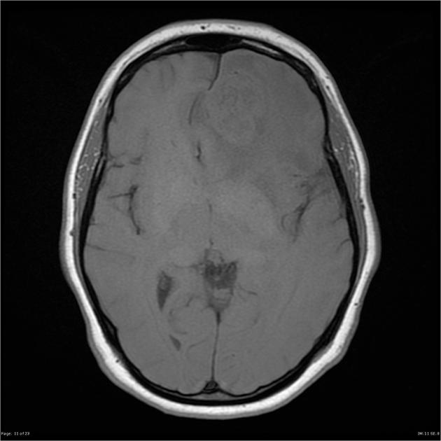 Solitary fibrous tumors of the dura