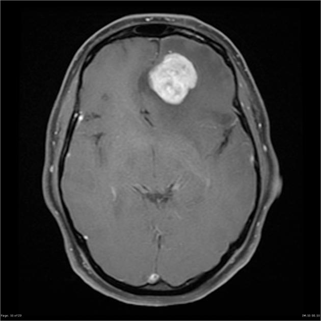 Solitary fibrous tumors of the dura
