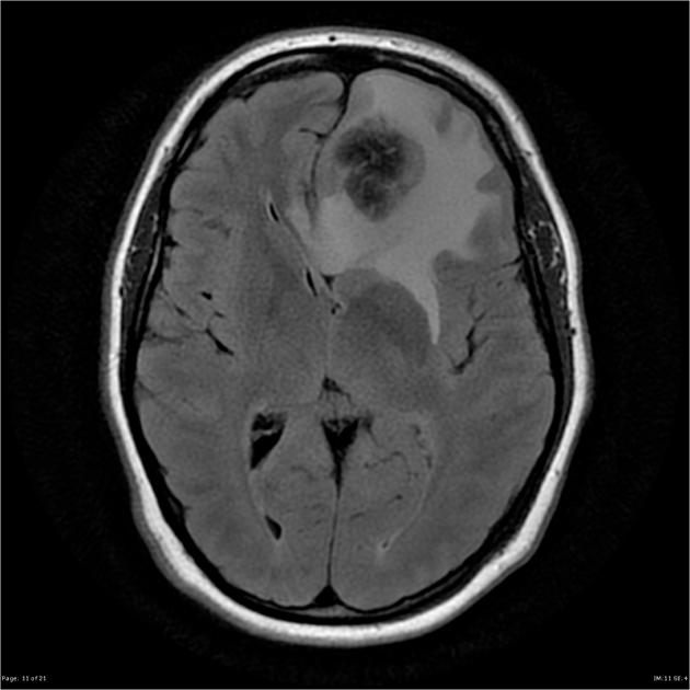 Solitary fibrous tumors of the dura