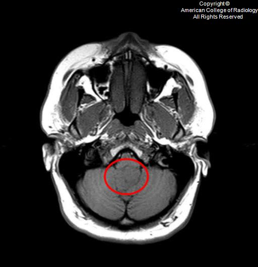 T1 - 25-year-old female