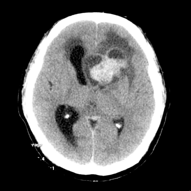 Ependymoma



Large, heterogeneous mass is present within the left frontal lobe. 



It is strikingly hyperdense, without definite calcification. 



The solid component enhances. Hydrocephalus is present, best seen on the right, due to outflow obstruction