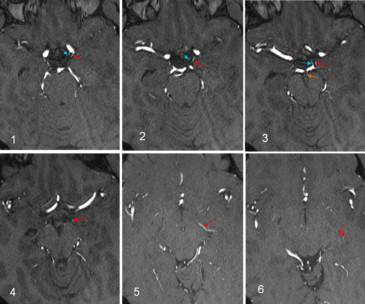 Sequential MR angiographic images tracing the anterior choroidal artery course