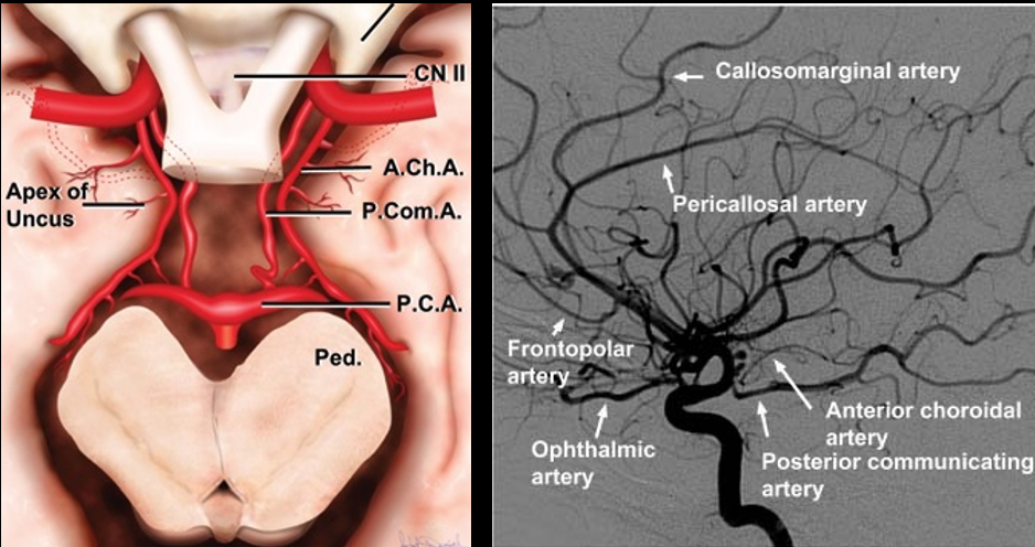 Anatomic illustration and angiogram showing the anterior choroidal artery origin from the internal carotid artery