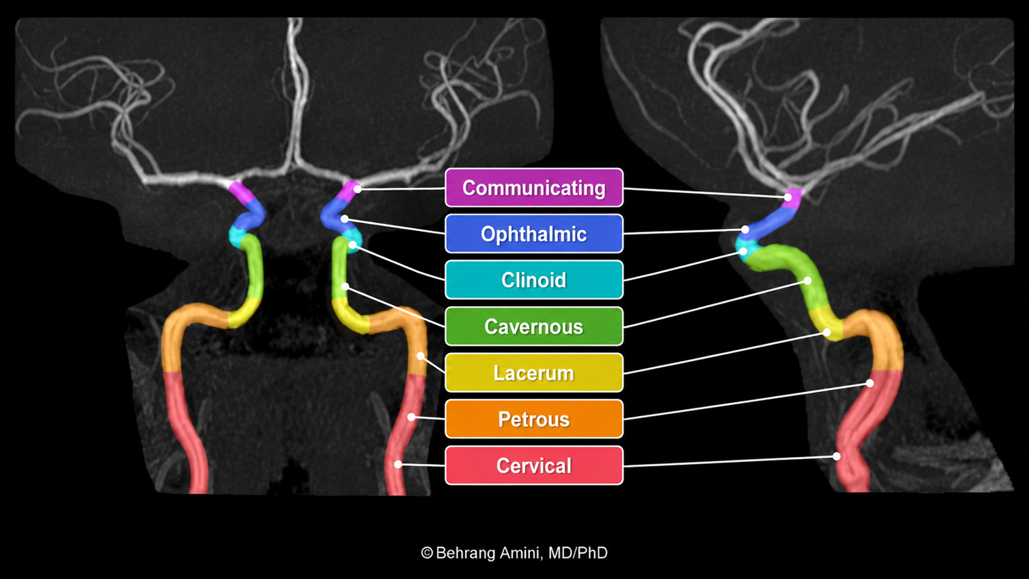 Color-coded Bouthillier ICA segments on MRA
