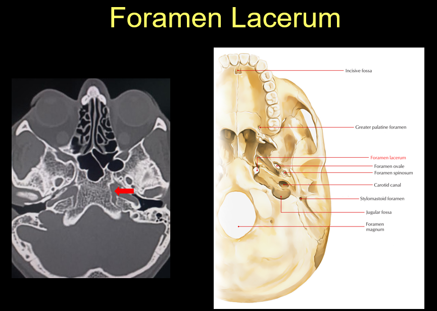 Foramen lacerum on CT and skull diagram