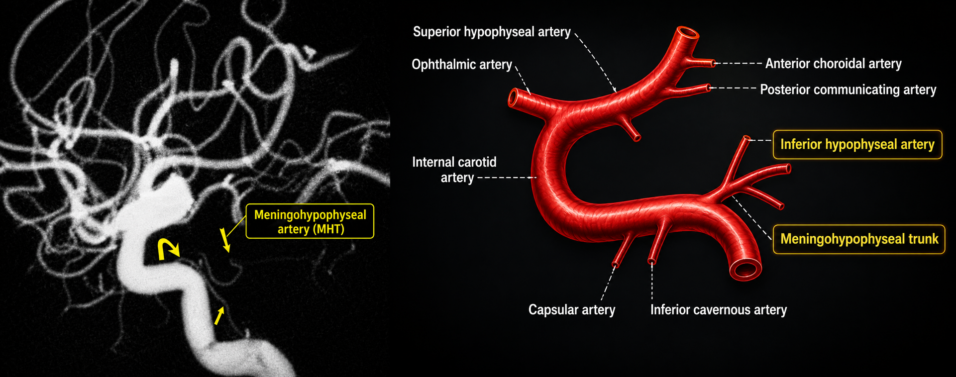 Angiographic and three-dimensional illustration of the meningohypophyseal trunk and inferior hypophyseal artery
