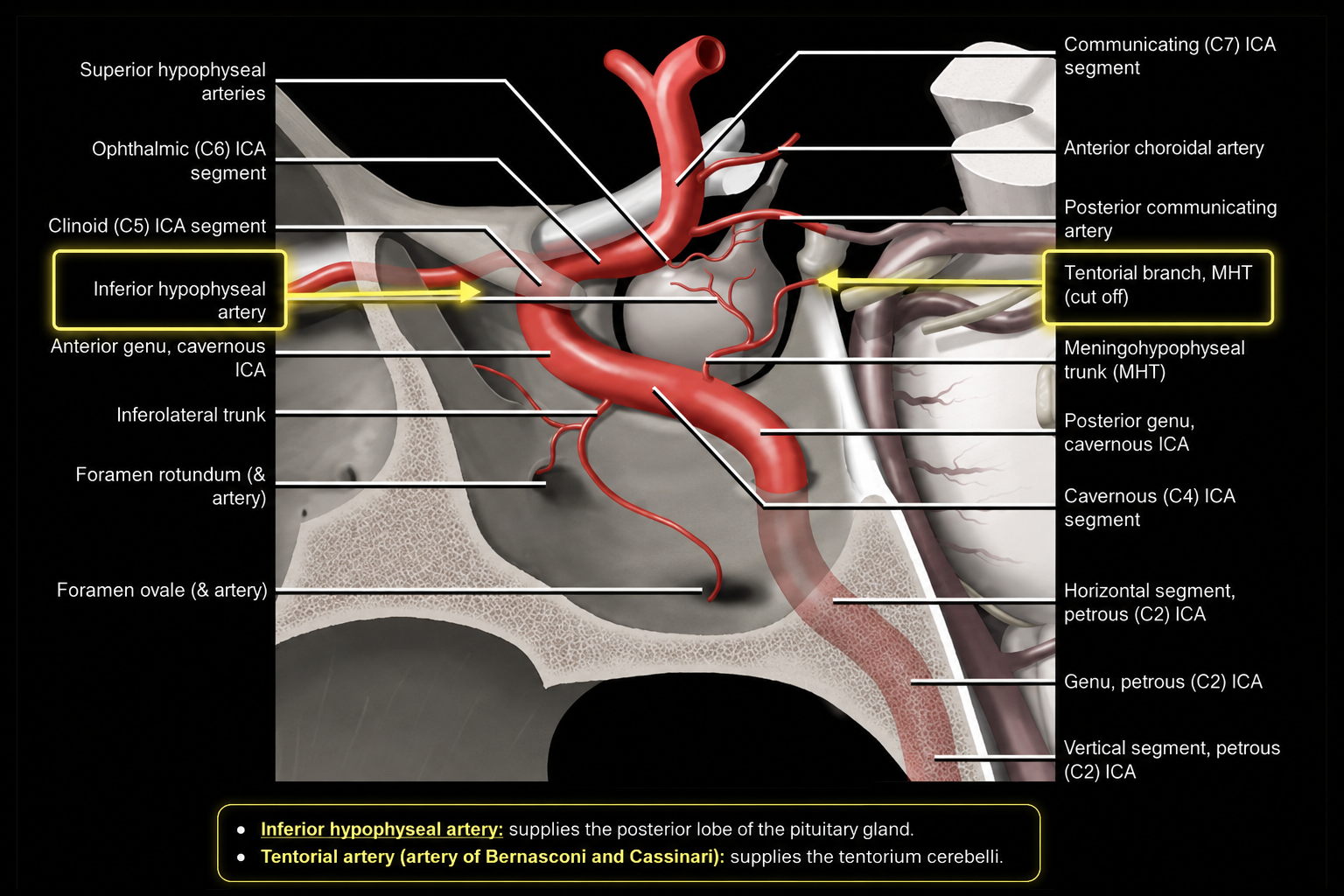 Cavernous internal carotid artery anatomy showing the meningohypophyseal trunk and inferior hypophyseal and tentorial branches
