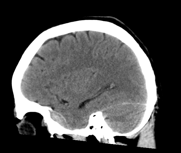 Anterior temporal extradural hematoma