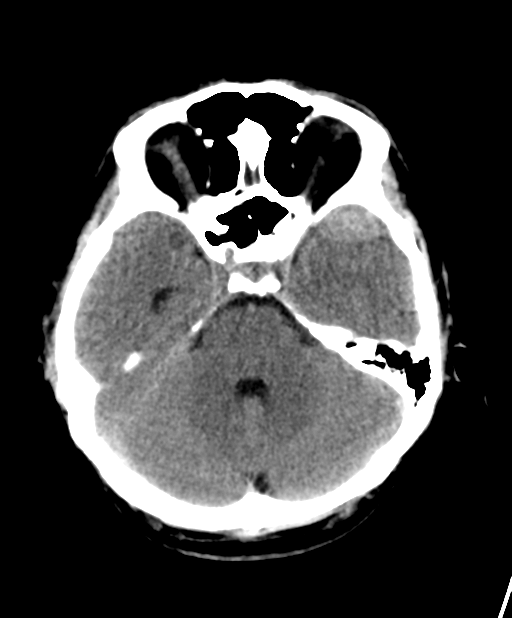 Anterior middle cranial fossa extradural hemorrhages are thought to arise from the sphenoparietal sinus which runs along the superior margin of the greater wing of sphenoid. 
Due to their location, the anatomy of dural attachments and venous origin, they do not cause midline shift or herniation, rarely grow, and can generally be managed conservatively