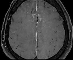 Granulomatous vasculitis
