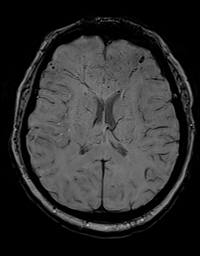 Granulomatous vasculitis