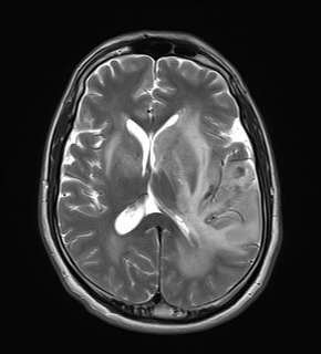 Primary CNS vasculitis