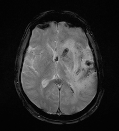 Primary CNS vasculitis