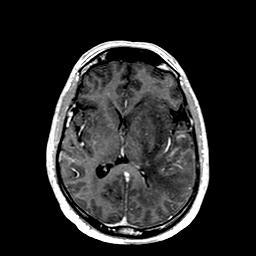 Primary CNS vasculitis