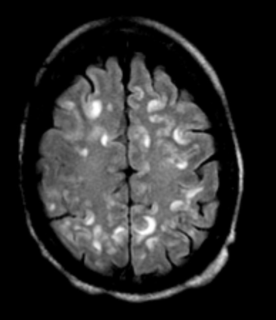 Secondary to SLE
