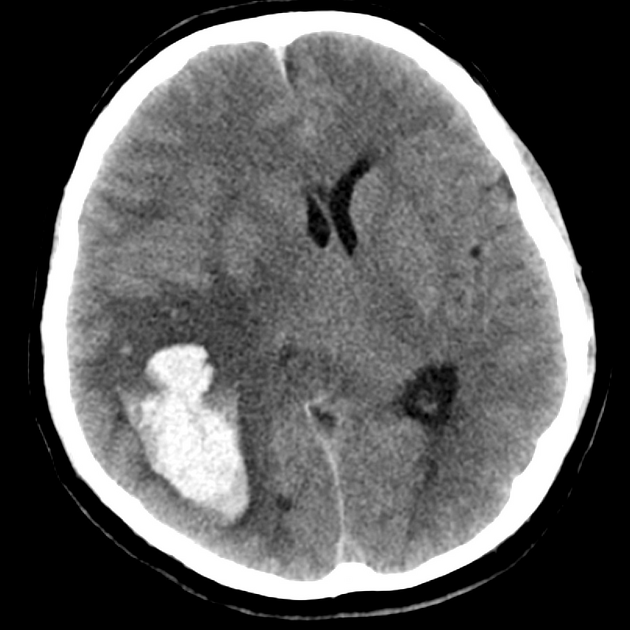 Lobar intracerebral hemorrhage on CT