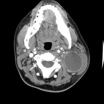 3rd branchial cleft cyst