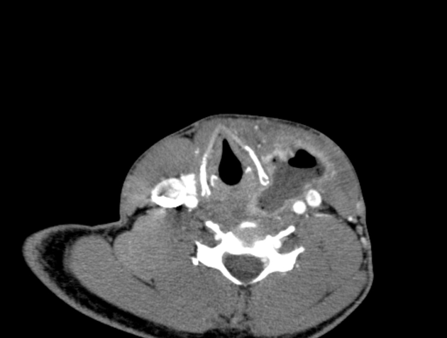 Infected 4th branchial cleft cyst