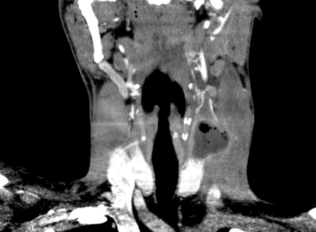 Infected 4th branchial cleft cyst