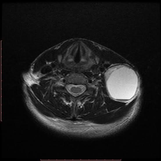 3rd branchial cleft cyst