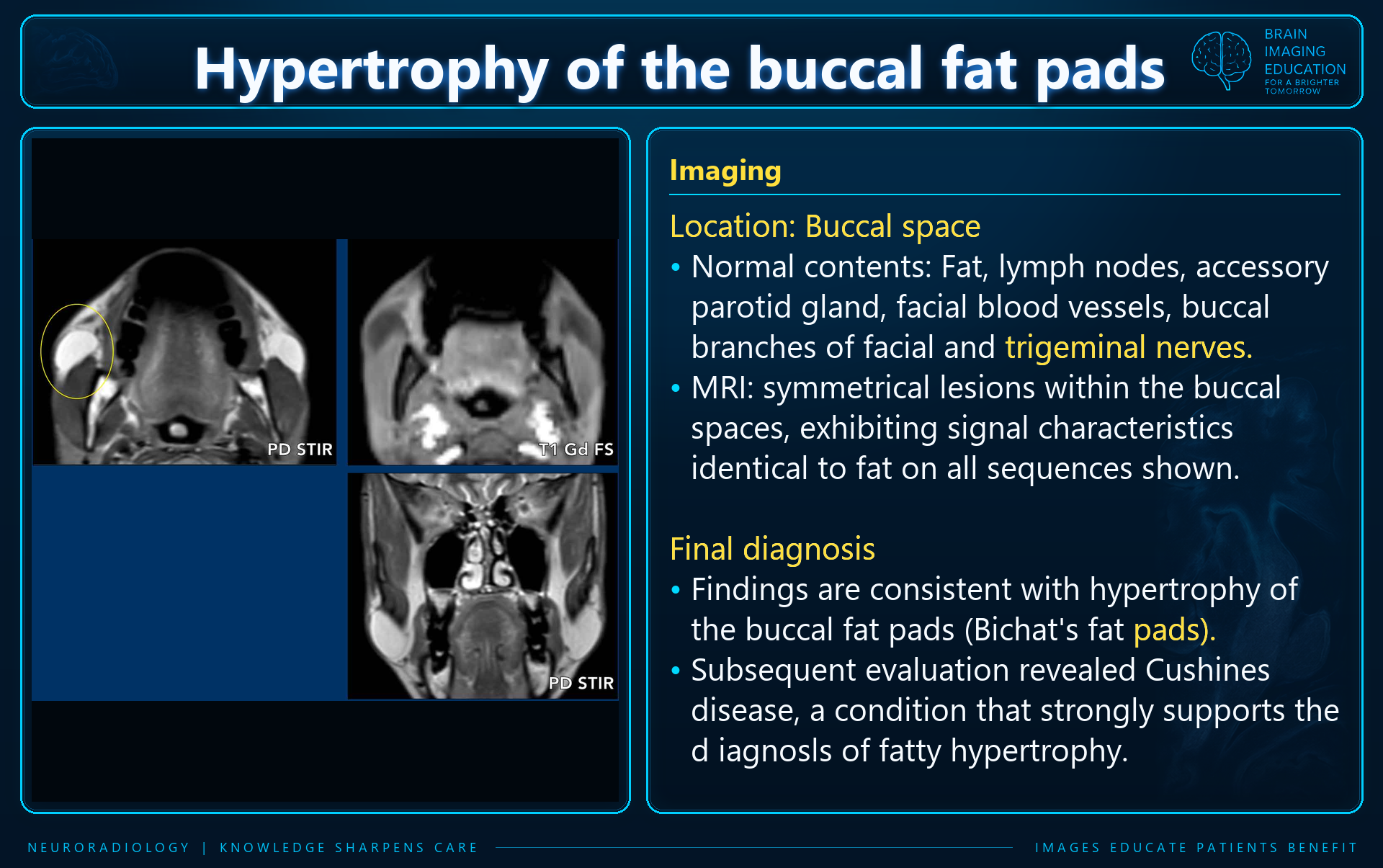 Teaching slide with axial and coronal MRI labeled PD STIR and T1 Gd FS, showing symmetric buccal lesions
