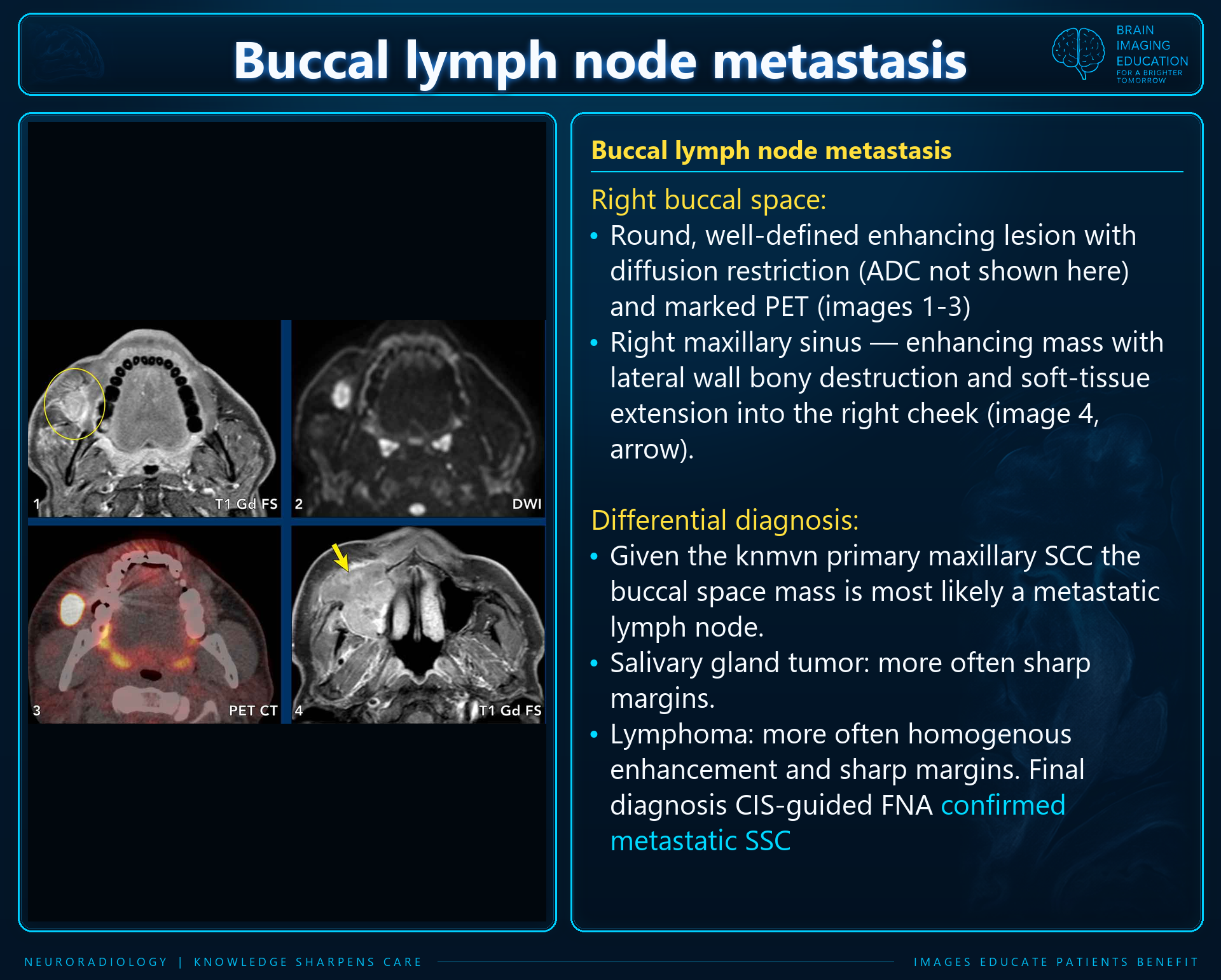 Teaching slide with axial contrast-enhanced MRI, DWI and PET-CT showing a labeled right buccal lesion and right maxillary sinus mass