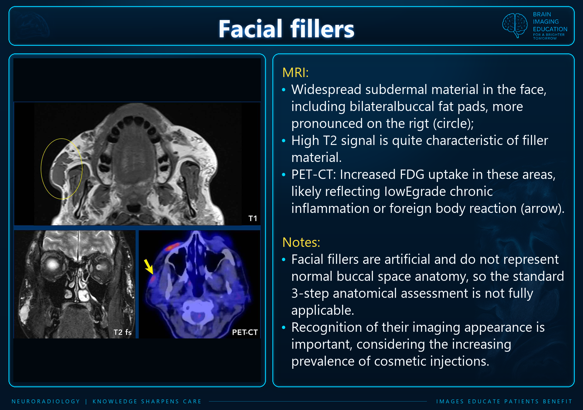 Teaching slide with axial T1 MRI, coronal T2 fat-suppressed MRI and axial PET-CT showing annotated facial filler material