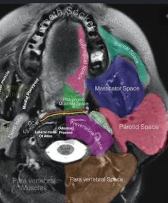 Axial cross-sectional image with colored labels identifying buccal, masticator, parotid and adjacent spaces