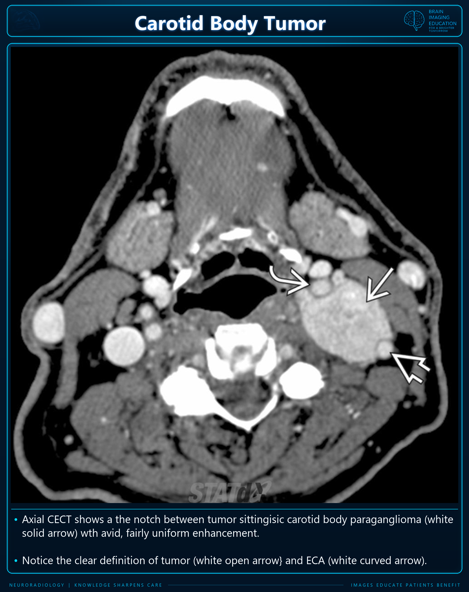 Carotid Body Tumor