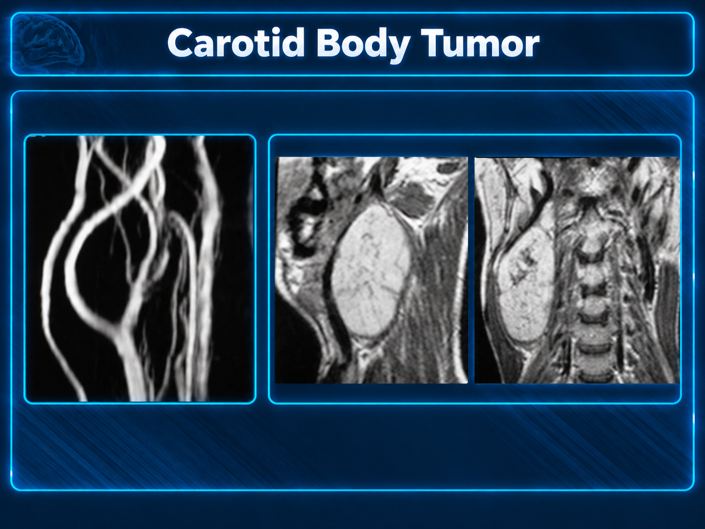 Carotid Body Tumor