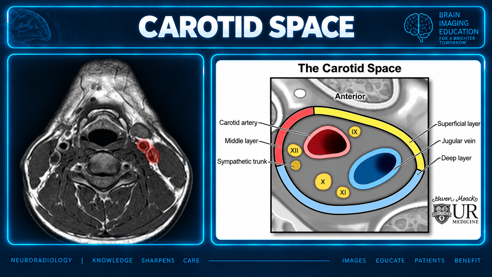 Axial neck MRI with a red carotid space overlay beside a labeled axial carotid sheath diagram showing the carotid artery, jugular vein, cranial nerves and fascial layers.