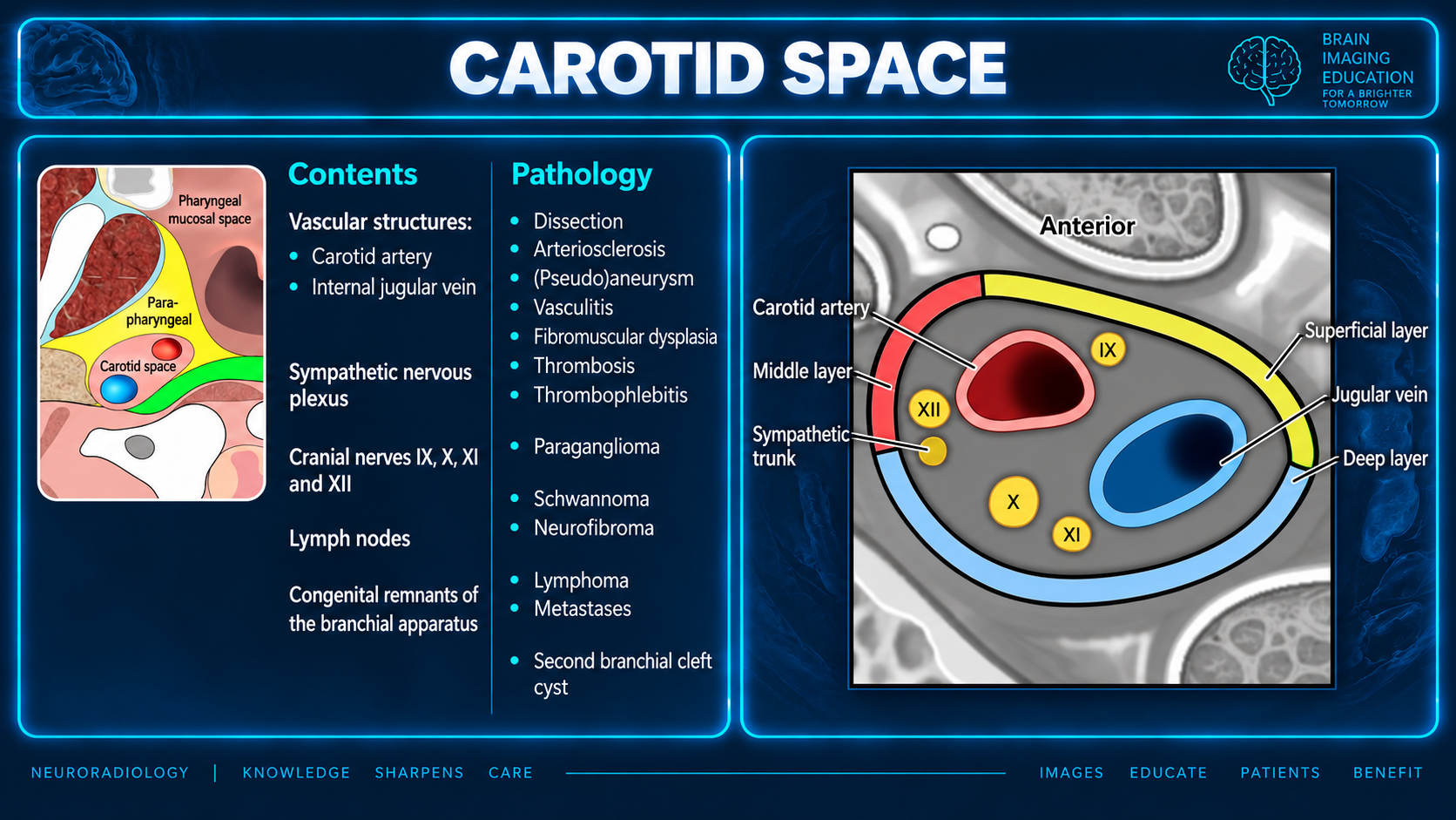 Teaching slide showing carotid space contents and pathology beside an axial diagram labeling the carotid artery, jugular vein, cranial nerves IX to XII, sympathetic trunk and fascial layers.