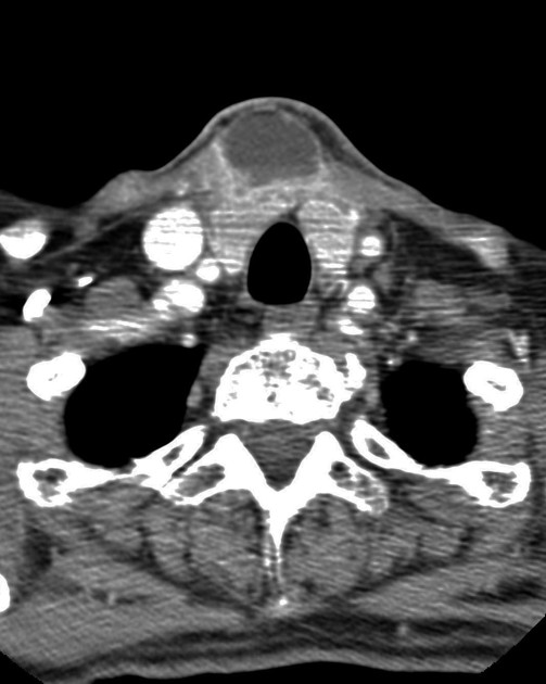 Delphian node in squamous cell carcinoma recurrence