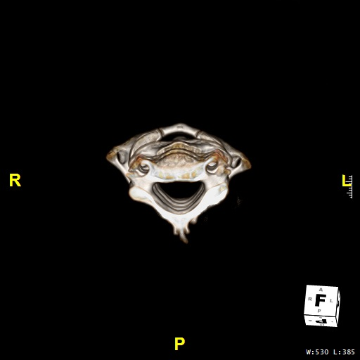 Mild rotatory subluxation of C1 over C2