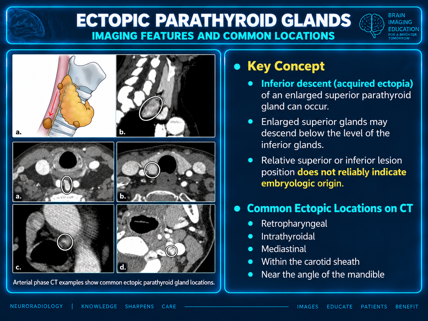 Illustration and CT examples of ectopic parathyroid gland locations, with teaching points about inferior descent of enlarged superior glands