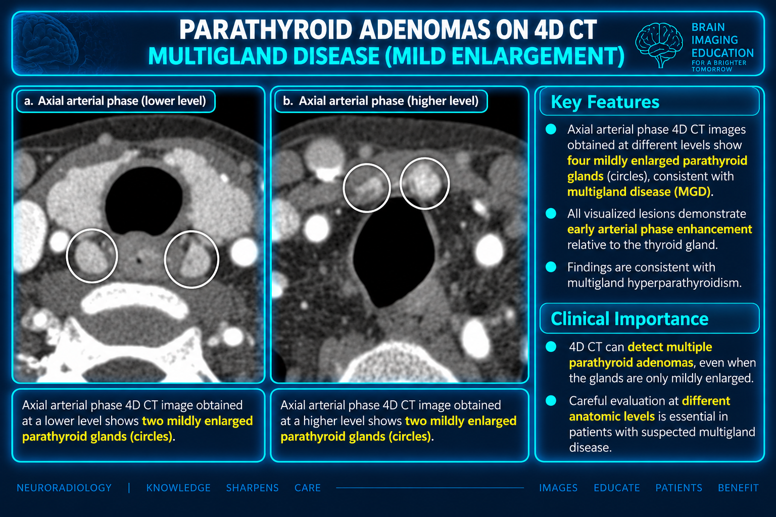 Axial arterial phase CT panels at lower and higher levels with circles marking four mildly enlarged parathyroid glands
