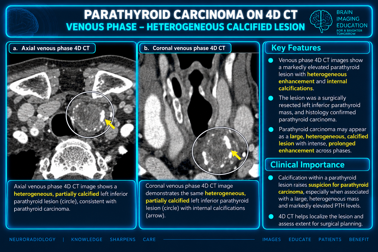 Axial and coronal venous phase CT panels with a circled heterogeneous partially calcified left inferior parathyroid lesion labeled histologically confirmed carcinoma