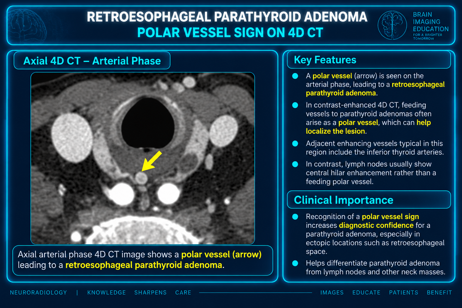 Axial arterial phase 4D CT teaching figure with an arrow marking a polar vessel associated with a retroesophageal parathyroid adenoma