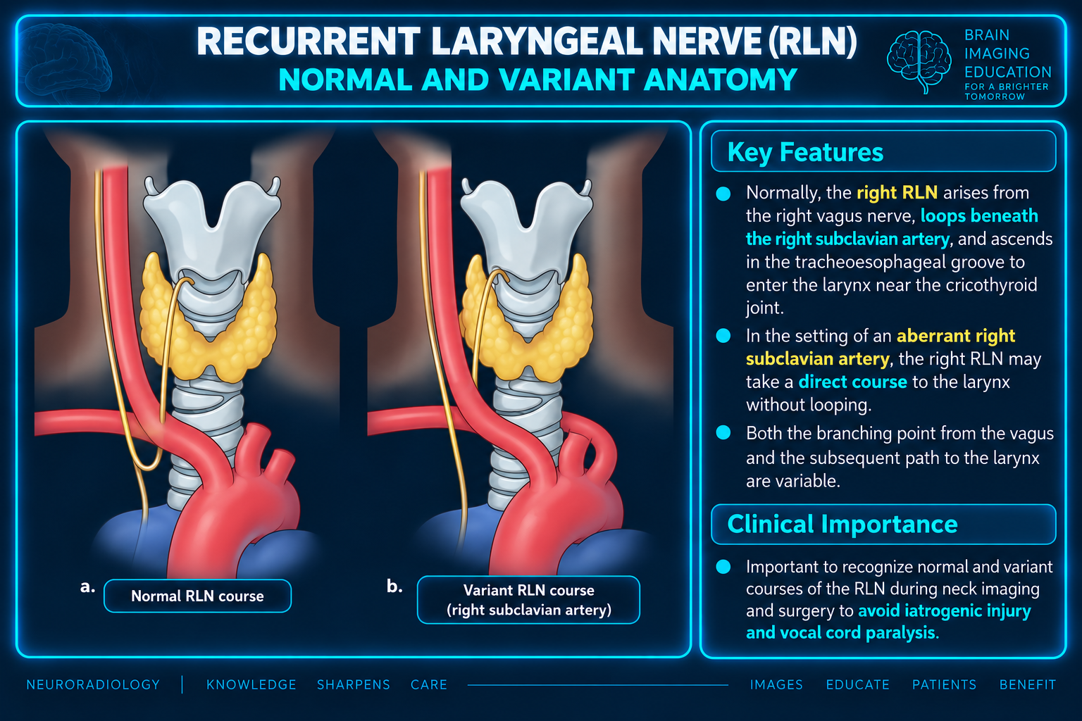 Anatomic illustration comparing a recurrent right laryngeal nerve course with a direct variant course associated with right subclavian anatomy