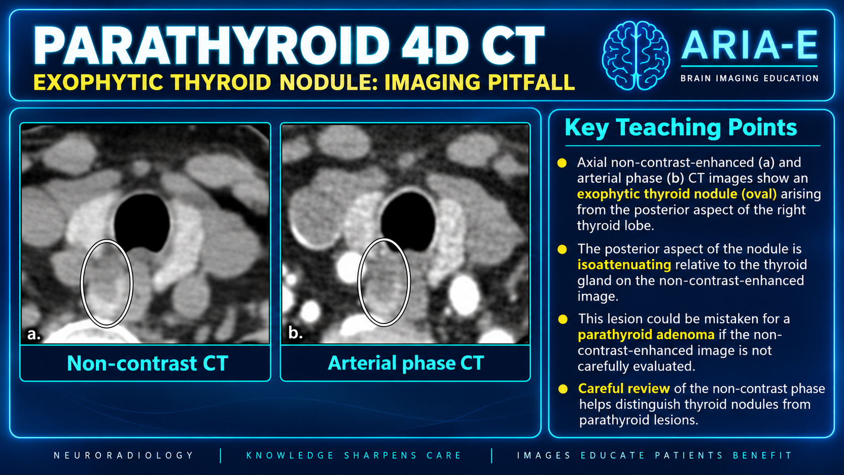 Axial noncontrast and arterial phase CT teaching panels with an oval marking an exophytic posterior right thyroid nodule