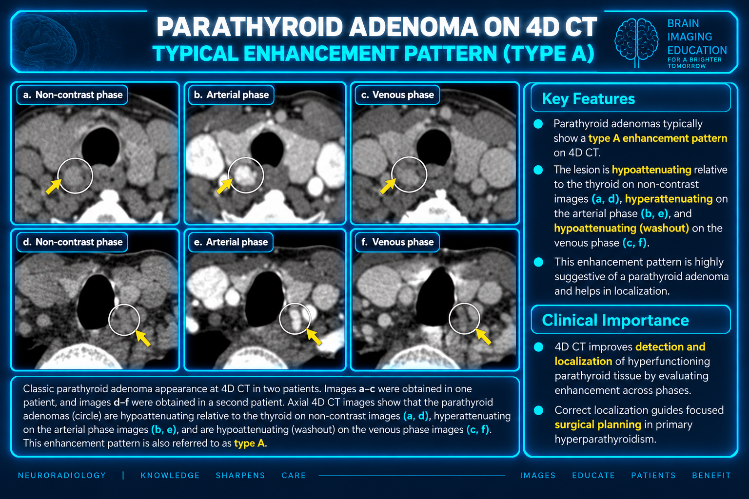 Axial 4D CT panels showing annotated parathyroid adenomas across noncontrast, arterial and venous phases