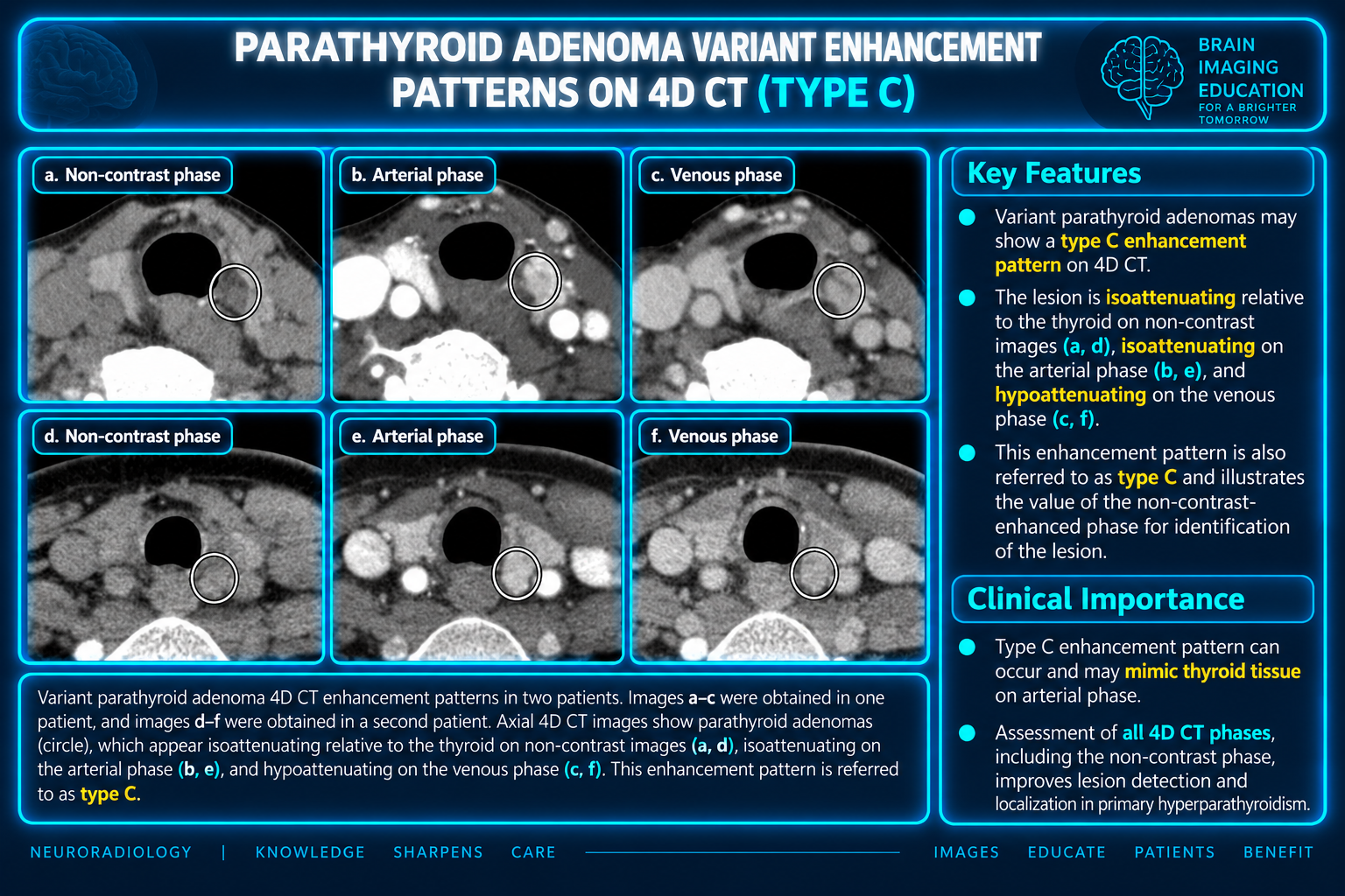 Axial noncontrast, arterial and venous CT panels labeled Type C, with circled parathyroid lesions in two patients