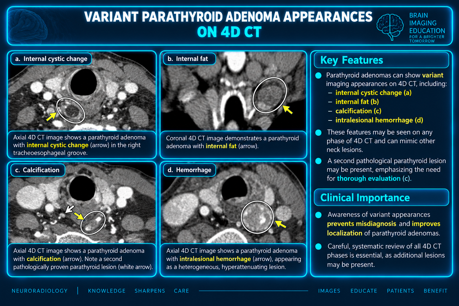 Axial and coronal 4D CT teaching panels showing cystic change, internal fat, calcification and hemorrhage in annotated parathyroid lesions