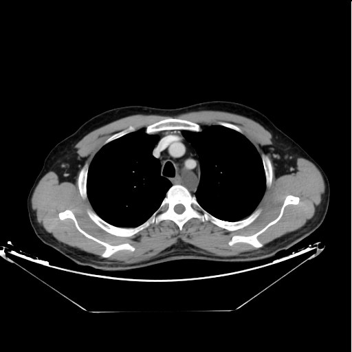 Lymphocele of the thoracic duct



Starting caudally from the level of the renal hila in the abdomen 



Extending cranially towards the mediastinum till its insertion with areas of more focal dilatation mounting to cyst formation.



Left supra-clavicular fossa well-defined oval shaped cyst is seen as well.
