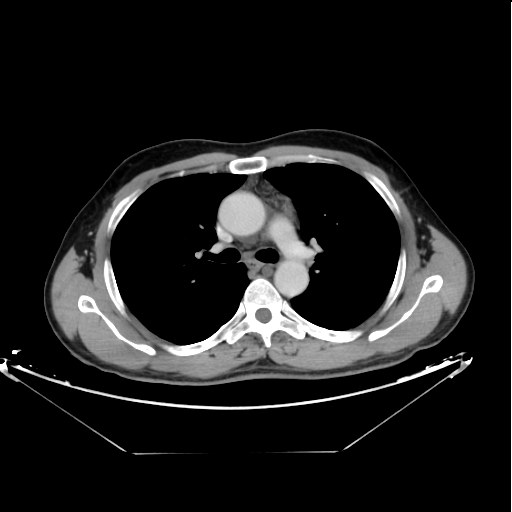 Lymphocele of the thoracic duct



Starting caudally from the level of the renal hila in the abdomen 



Extending cranially towards the mediastinum till its insertion with areas of more focal dilatation mounting to cyst formation.



Left supra-clavicular fossa well-defined oval shaped cyst is seen as well.