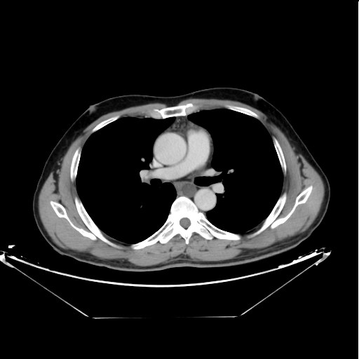 Lymphocele of the thoracic duct



Starting caudally from the level of the renal hila in the abdomen 



Extending cranially towards the mediastinum till its insertion with areas of more focal dilatation mounting to cyst formation.



Left supra-clavicular fossa well-defined oval shaped cyst is seen as well.