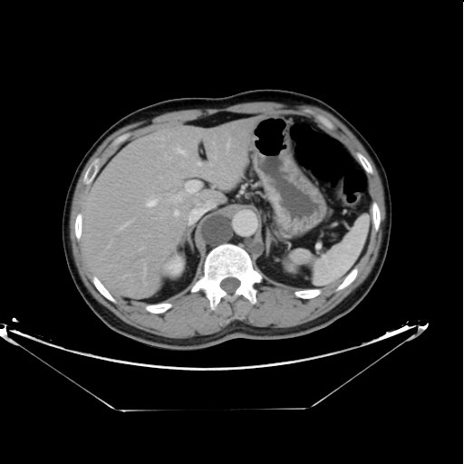 Lymphocele of the thoracic duct



Starting caudally from the level of the renal hila in the abdomen 



Extending cranially towards the mediastinum till its insertion with areas of more focal dilatation mounting to cyst formation.



Left supra-clavicular fossa well-defined oval shaped cyst is seen as well.